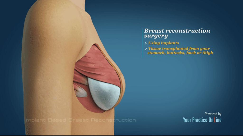 Breast Reconstruction options after a Mastectomy