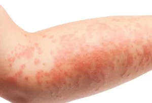 atopic eczema