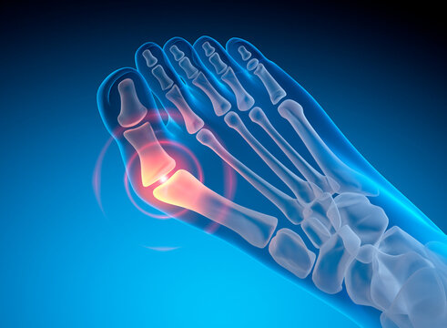 Bunion (Hallux Valgus)