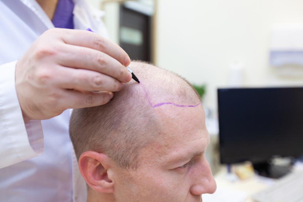 Things to consider before having a Hair Transplant