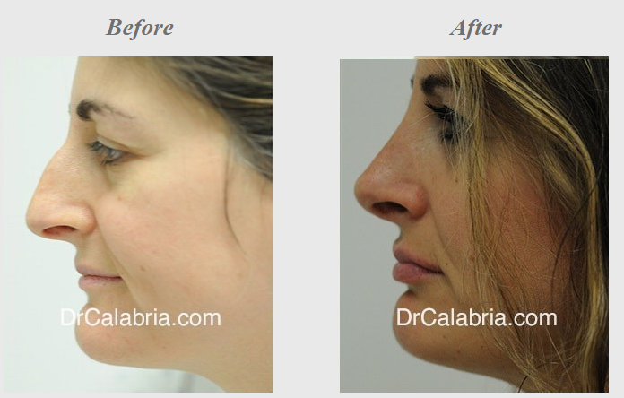 Natural remedies for a better Rhinoplasty recovery