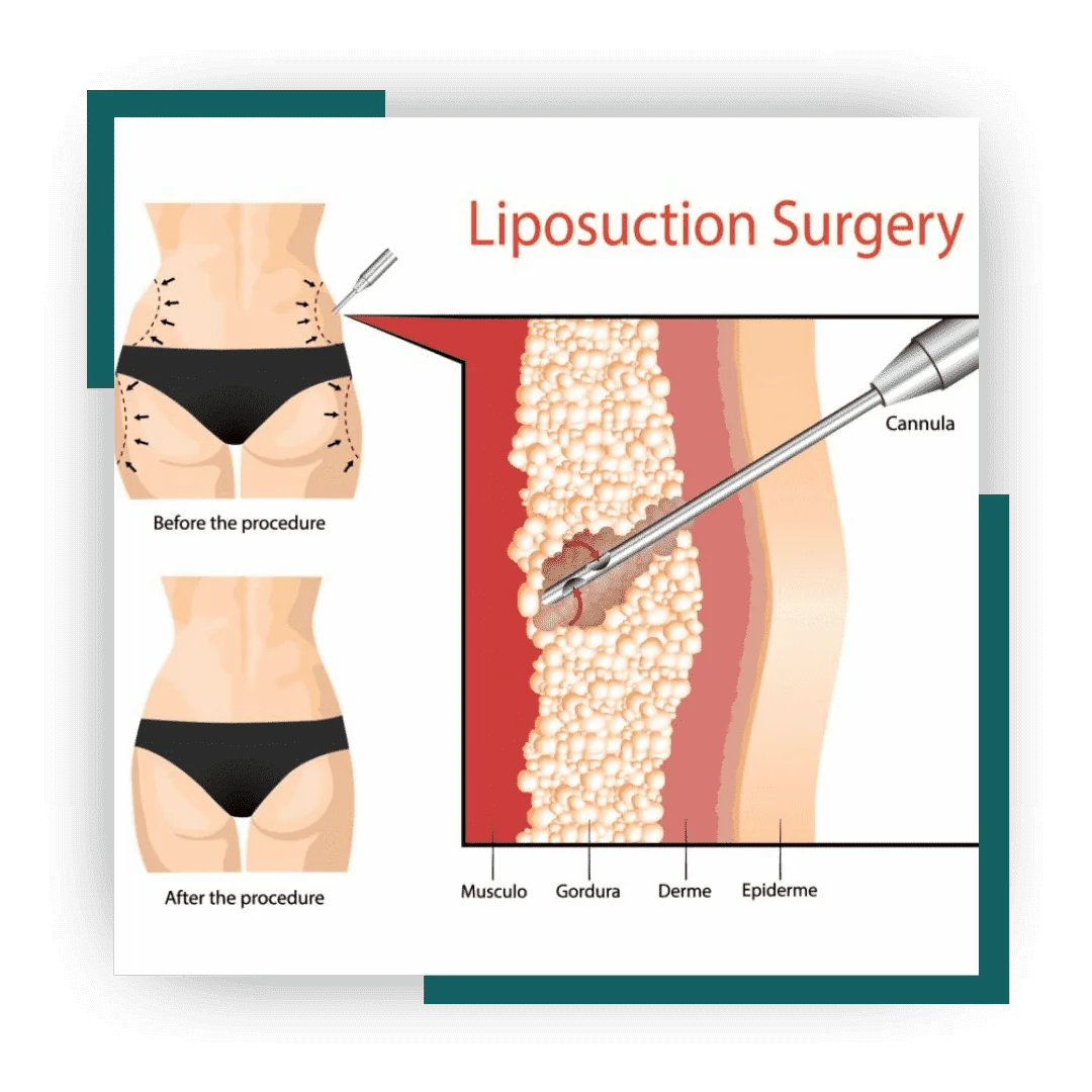 Liposuction: Best Technique for Fat Removal and Skin Tightening