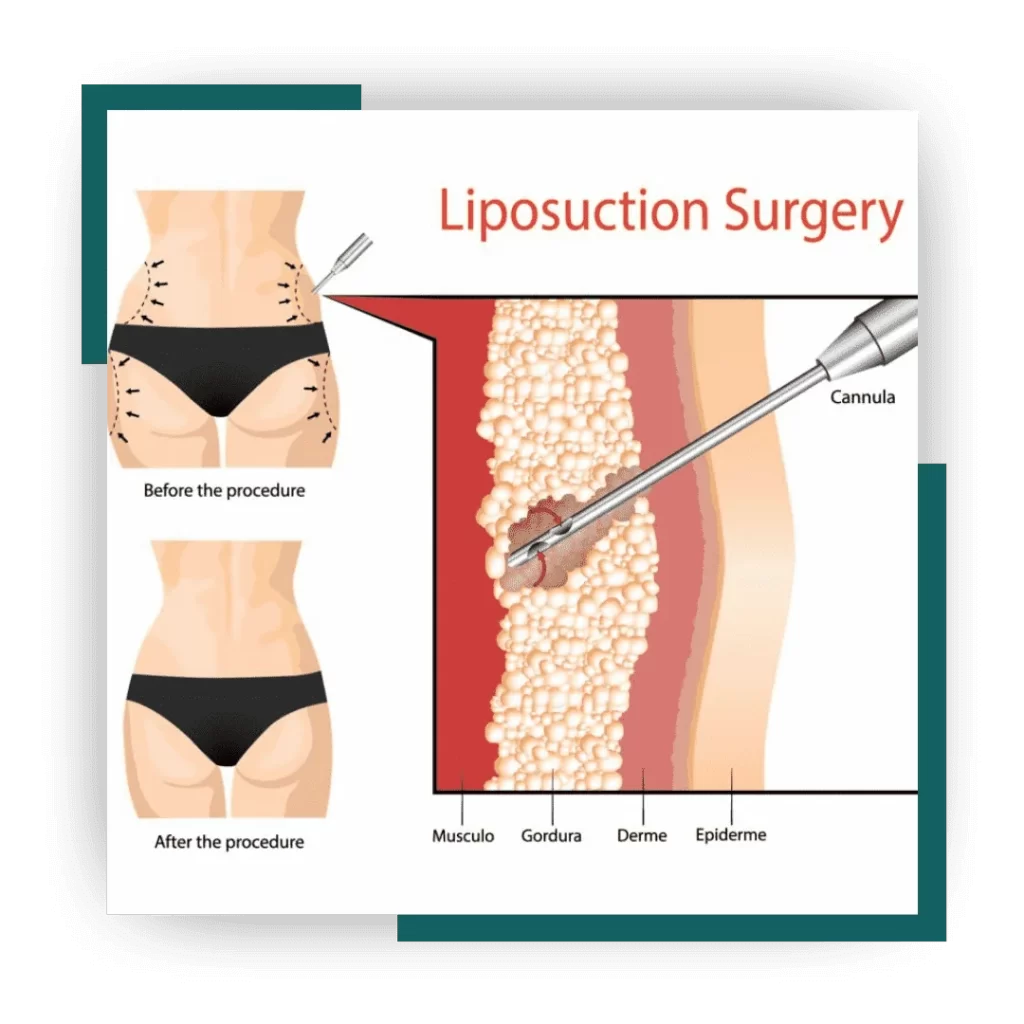 Liposuction: Best Technique for Fat Removal and Skin Tightening