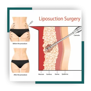 Myths about liposuction