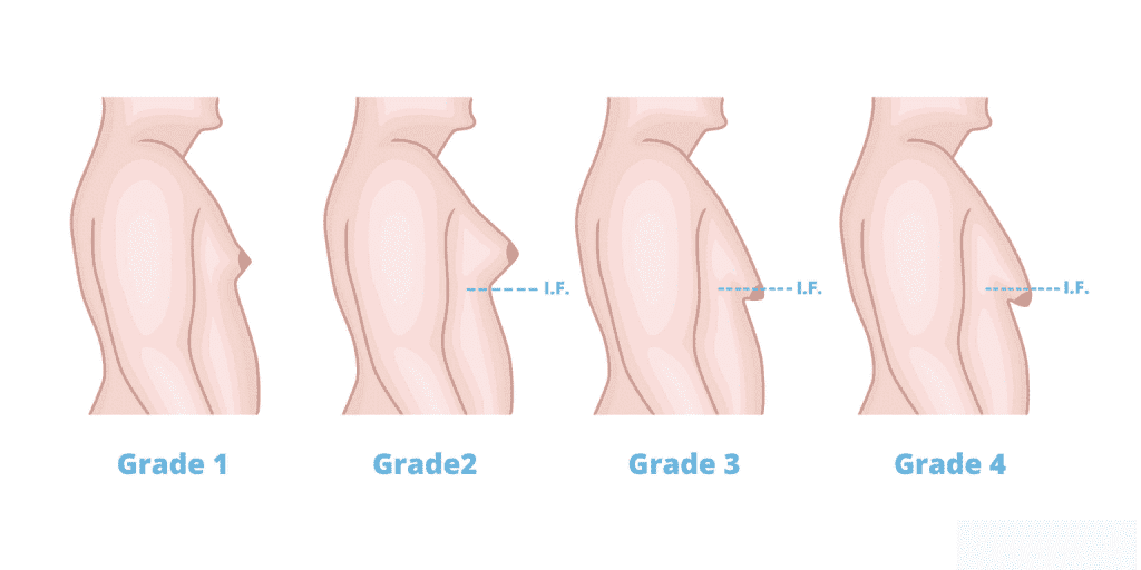 Gynecomastia- causes, diagnosis and treatment