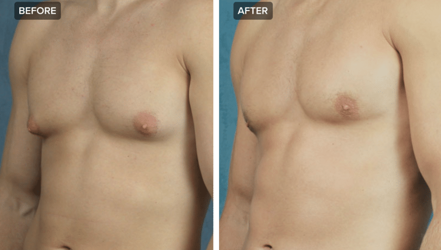 What is Gynecomastia? Causes, Symptoms and Treatment Cost