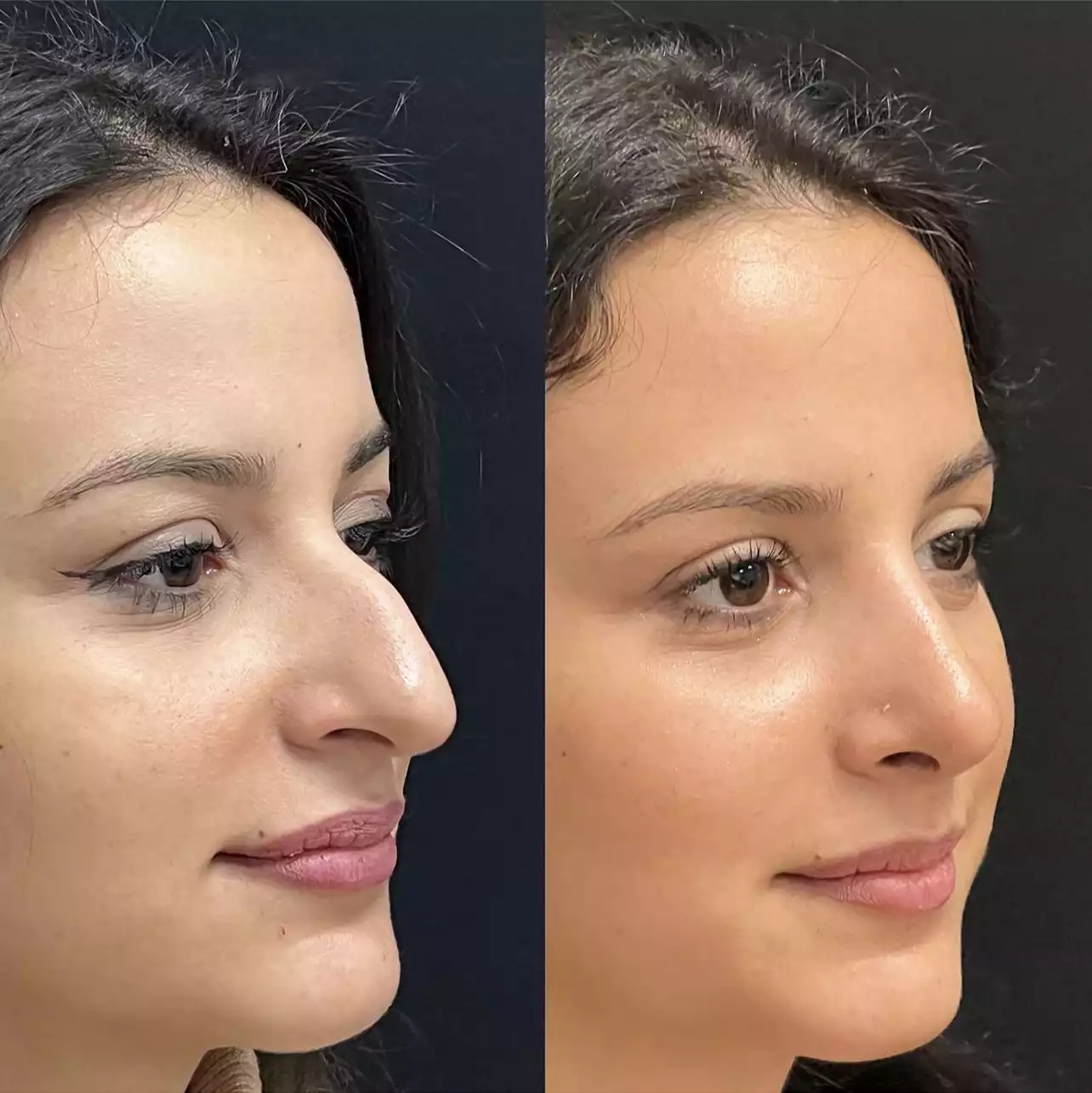 What makes you eligible for Rhinoplasty?