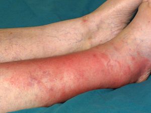 Symptoms of cellulitis