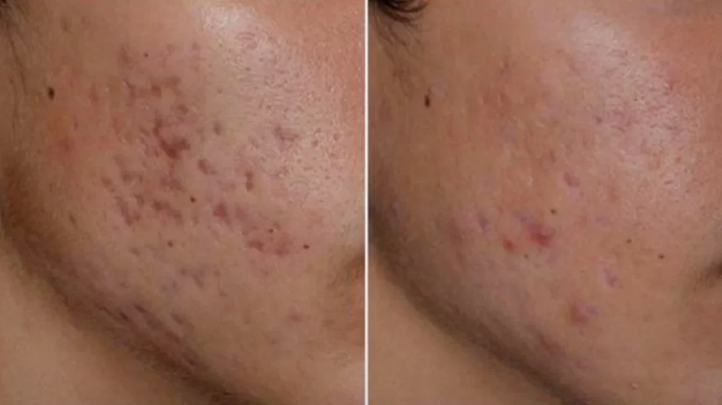 7 Types of Acne Scar Laser Treatments & Their Benefits