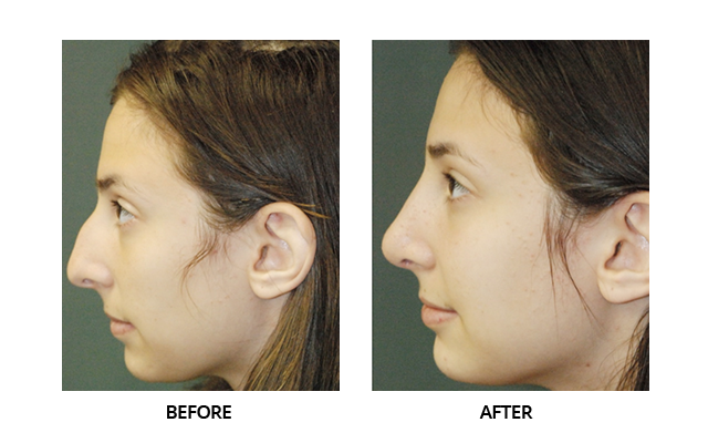 Natural remedies for a better Rhinoplasty recovery