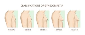 Difference Between Gynecomastia and Chest Fat