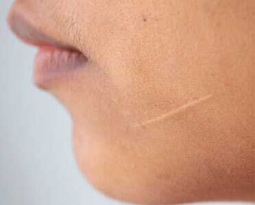 All You Need to Know About Scar Removal Treatment