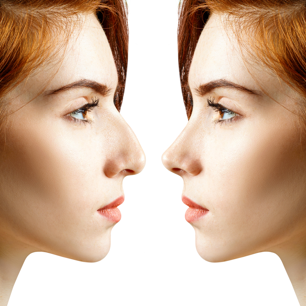 What makes you eligible for Rhinoplasty?