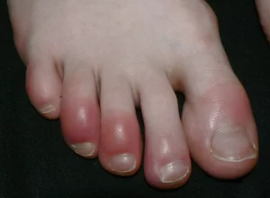 Symptoms of chilblains include: