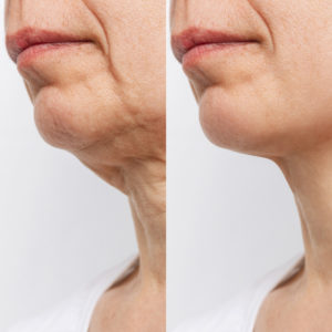 Natural After-Care Remedies for Facelift Surgery