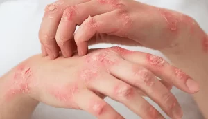 Symptoms of atopic eczema