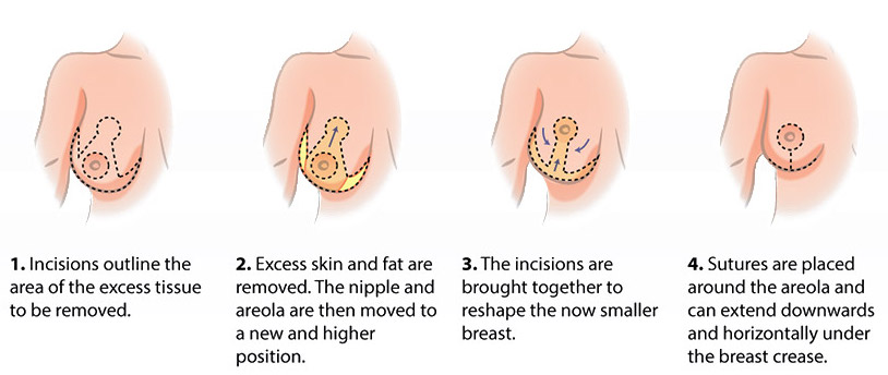 Things to Know If You’re Considering Breast Reduction Surgeries