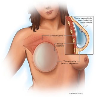 Breast Reconstruction options after a Mastectomy