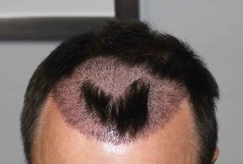 Things To Know About Hair Transplant And Its Side Effects