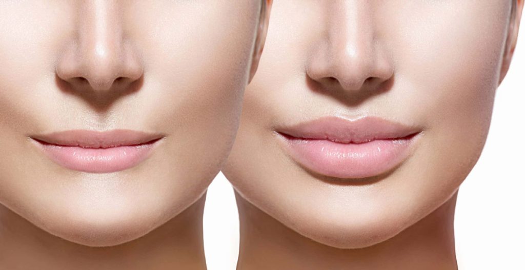 All You Need to Know about Lip Augmentation and its Treatment