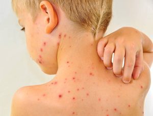 Chickenpox causes a rash of red, itchy spots that turn into fluid-filled blisters