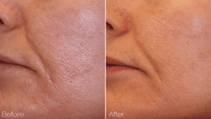 Pore Reduction Treatments