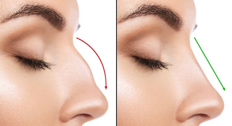 How Rhinoplasty (nose job) works?