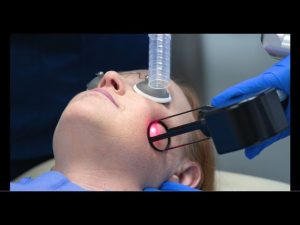 Fractional Laser Treatment