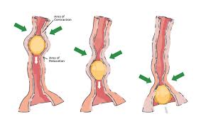 What is Peristalsis