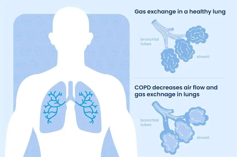 COPD Etiology and Pathophysiology