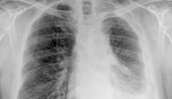 Mesothelioma: Everything You Need to Know