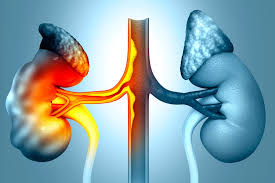 Polycystic Kidney Disease (PKD) - Everything you need to know