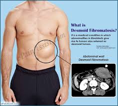 Desmoid Tumors - Everything you need to know