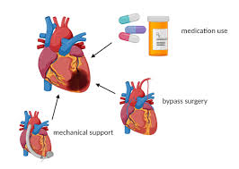 Heart Failure Treatments - Everything you need to know