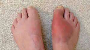 Gout Causes – Everything you need to know