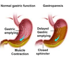 Gastroparesis – Everything you need to know