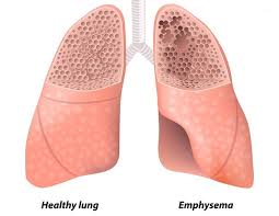 Emphysema - Everything you need to know