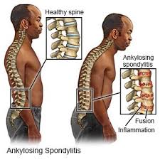 Ankylosing Spondylitis - Everything you need to know