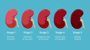 Chronic Kidney Disease (CKD) Stages - Everything you need to know