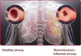 Bronchiectasis - Everything you need to know