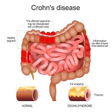 Crohn’s Disease - Everything you need to know