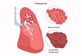 Emphysema Treatment – Everything you need to know