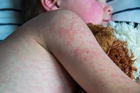 Measles - Everything you need to know