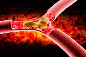 Arteriosclerosis - Everything you need to know