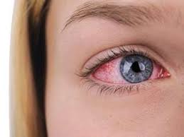 Conjunctivitis Treatments - Everything you need to know