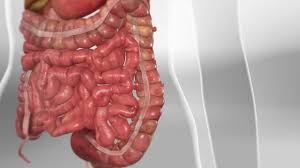 Diverticulosis – Everything you need to know