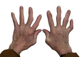Arthritis in the Fingers