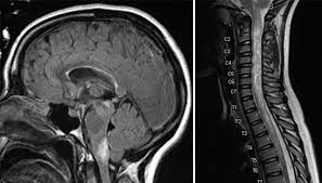 NMO (Neuromyelitis Optica) - Everything you need to know