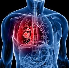 Lung Cancer – Everything you need to know