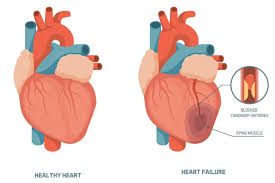 Heart Failure Symptoms – Everything you need to know